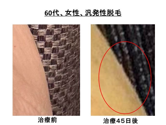 円形脱毛症　病院